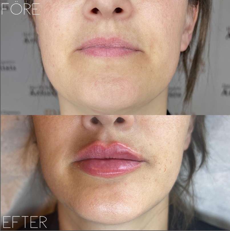 Före & Efter - Läppar - IDANA Beauty (3)