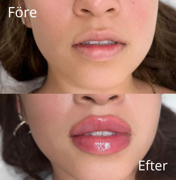 Före & Efter - Läppar - IDANA Beauty (4)