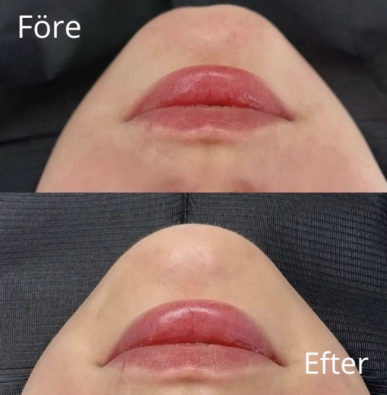 Haka - Före & Efter - IDANA Beauty (2)