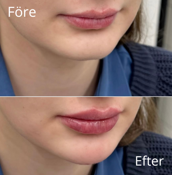 Haka - Före & Efter - IDANA Beauty