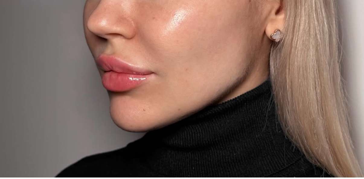 Jawline - Efter - IDANA Beauty
