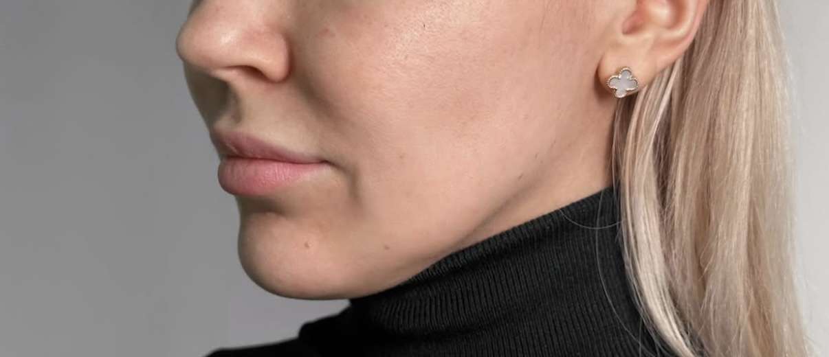 Jawline - Före - IDANA Beauty
