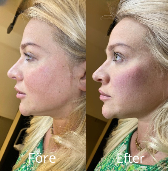 Kinder - Före & Efter - IDANA Beauty